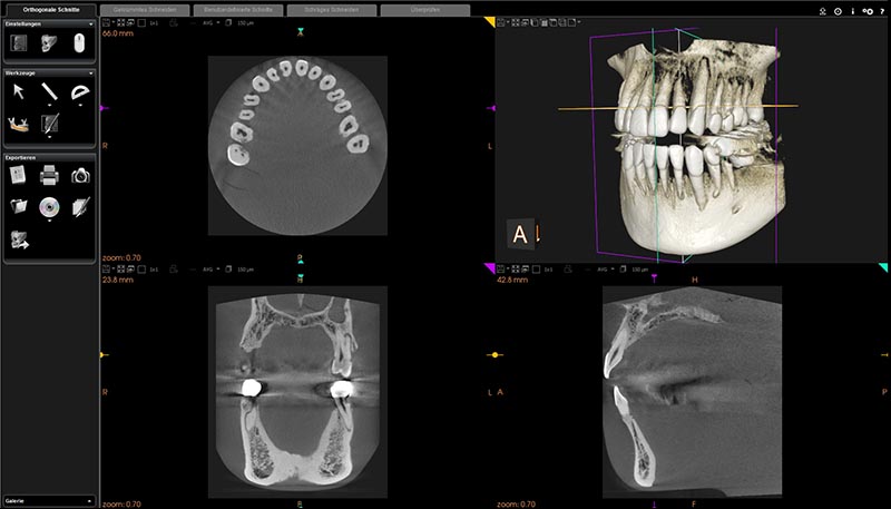 Mit dem DVT wird der Patient im Vergleich zu einem klassischen CT nur einem Bruchteil der Strahlenbelastung ausgesetzt.
