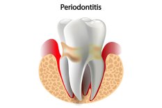 Individuelle paradontale Therapien bei einer Parodontitis, umgangssprachlich auch Parodontose genannt, der entzündlichen Zerstörung des Zahnhalteapparats