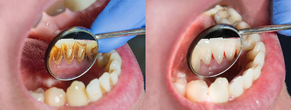 Die Prophylaxe und die Dentalhygiene in unserer Zahnarztpraxis Dr. Kessler gehen mit Politur und Fluoridierung weit über die gewöhnliche Zahnstein-Entfernung hinaus.