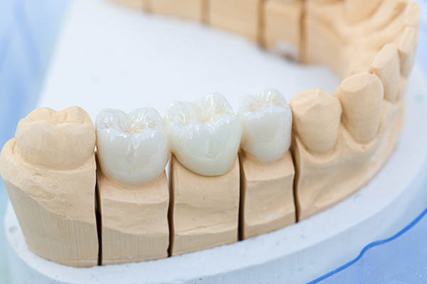 Eine Brücke empfiehlt sich, wenn einer oder mehrere Zähne fehlen. Dieser Zahnersatz wird entweder an den Nachbarzähnen oder einem Implantat befestigt