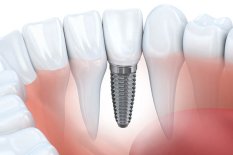 Zahnimplantate für den sicheren Halt von Kronen, Brücken und Prothesen. Computergestützte, dreidimensionale Implantatplanung – Guided Implantology