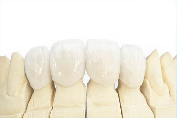 Ist ein Zahndefekt bereits zu gross für eine Rekonstruktion mit einer Füllung und ist bereits zuviel Zahnsubstanz verloren, kann eine Teil- oder Vollkrone zum Einsatz kommen