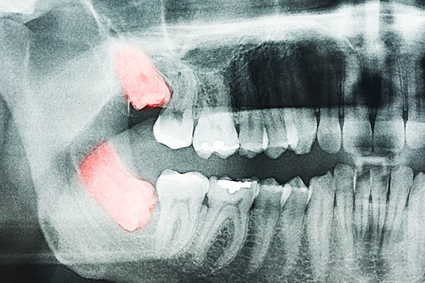 Sind die Weisheitszähne regulär durchgebrochen und integrieren sich in die Zahnreihe, hat der Zahnerhalt auch hier Priorität. Im Falle einer Retention sollte extrahiert werden