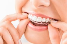 Individuell angefertigte Zahnschienen können helfen: Aufbiss-Schienen bei Zähneknirschen (Bruxismus), Schnarchschiene bei Schnarchen. Familienzahnarzt Dr. Kessler, Wollerau